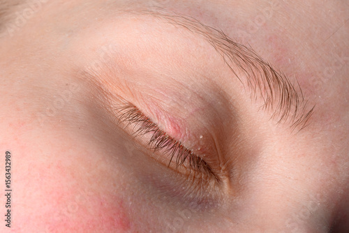 Closed eye, visible symptoms of Demodex on the eyelid, glued eyelashes, redness and itching of the eye