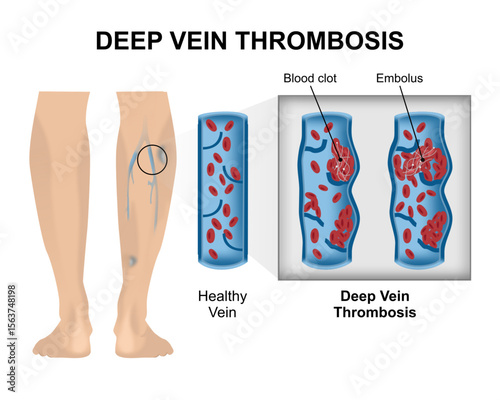 Deep Vein Thrombosis (DVT) Illustration