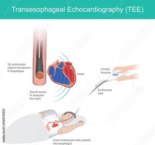 illustrates the Transesophageal Echocardiography (TEE) procedure, a diagnostic medical imaging technique used to obtain detailed images of the heart.