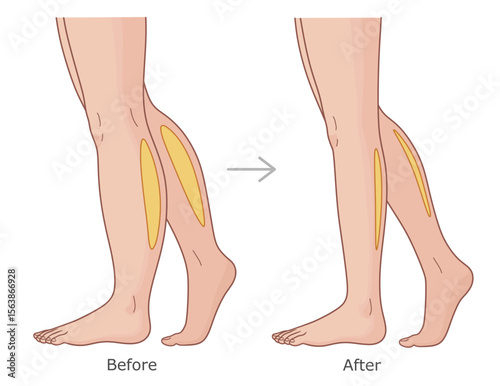 Calfs before and after weight loss. Slimming of calfs vector illustration.