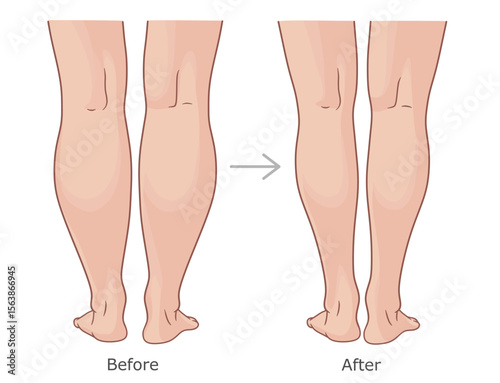 Back view of calfs before and after weight loss. Slimming of calfs vector illustration.
