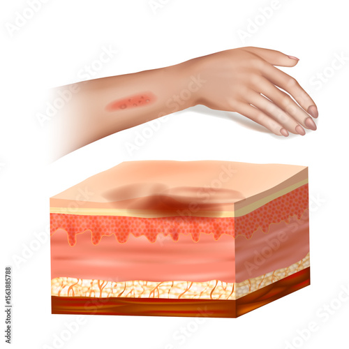 Skin Lesion Cross-Section with Infected Tissue on Human Arm. Medical Illustration of Skin Infection and Subcutaneous Inflammation