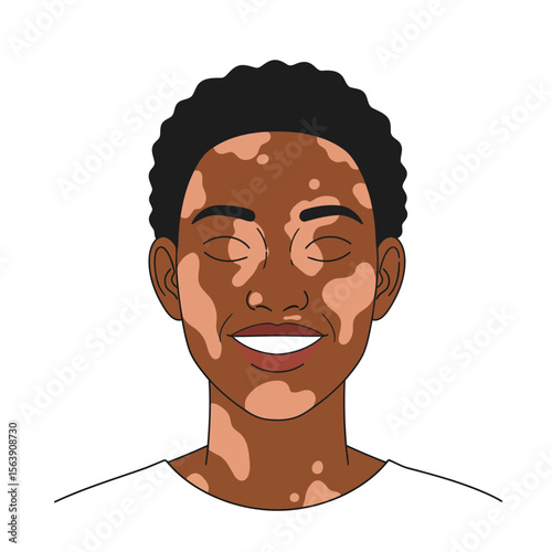 Embracing Uniqueness: A heartwarming illustration of a smiling individual showcasing vitiligo, celebrating skin diversity and promoting self-acceptance.