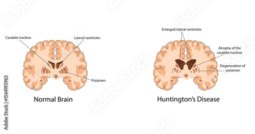 Huntington's disease vector illustration
