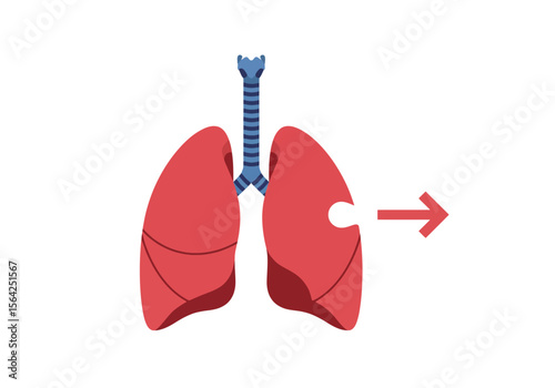 Damaged Human Lungs with Missing Piece Medical Illustration.