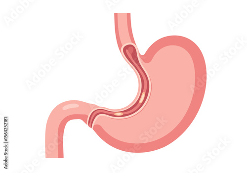 Detailed Illustration of Human Stomach with Internal Lining and Gastric Ulcers.