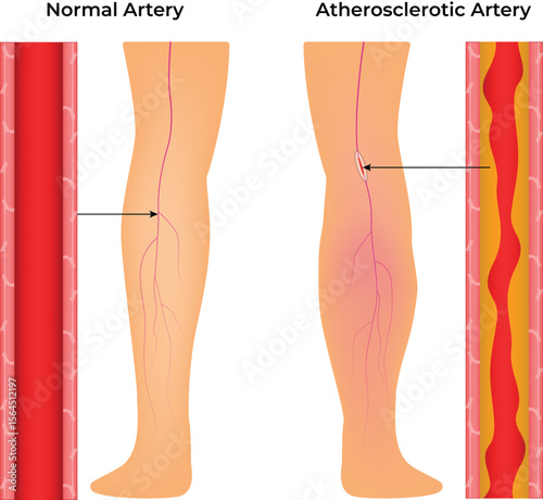 Atherosclerosis Normal vs Atherosclerotic Artery Comparison