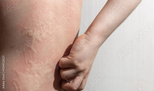 Kid with an aggressive form of hives, nettle rash on back. Child with inflamed ear on white background scratching skin. Red, itchy welts common in children's allergic skin reactions.