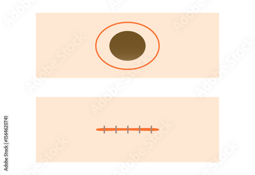 Mole Removal and Suture Method Illustration