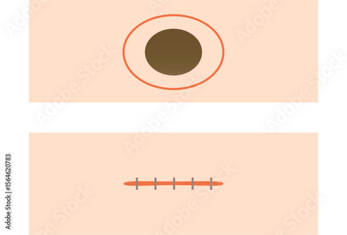Mole Removal and Suture Method Illustration