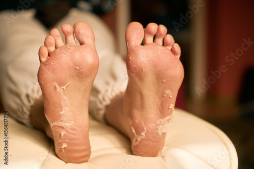Patient relaxes her feet after a chemical peel treatment, revealing smoother, softer skin