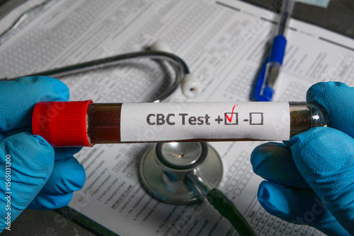 Slika na platnu Doctor holding cbc test tube with positive result near stethoscope and medical f