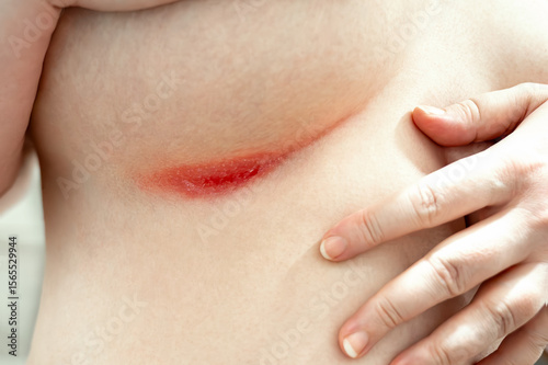 Close-up of severe red rash in breast fold. Intense skin irritation with visible damage and pain