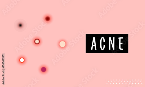 Acne Awareness Month. Acne and Skin Problem. Body skin acne type blackheads, whiteheads, papule, pustule, cyst and nodules. Acne types, skin pimples blackheads and face comedones