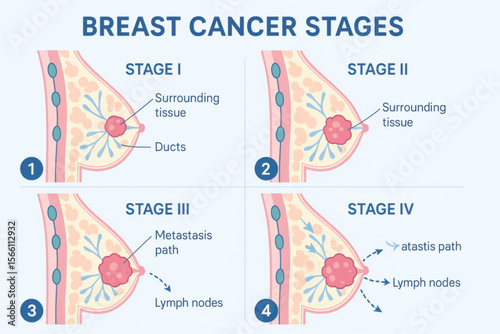 A 3D vector infographic displaying four stages of breast cancer progression with labeled tumors and affected tissues in cross-section view.