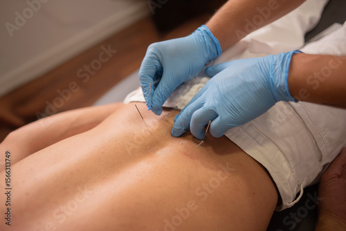 Professional physiotherapist is performing a dry needling on a patient's back.