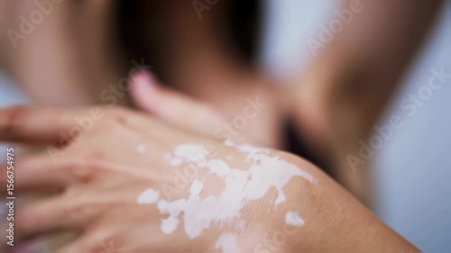An intimate closeup shot focuses on the hand and wrist of a person with vitiligo.