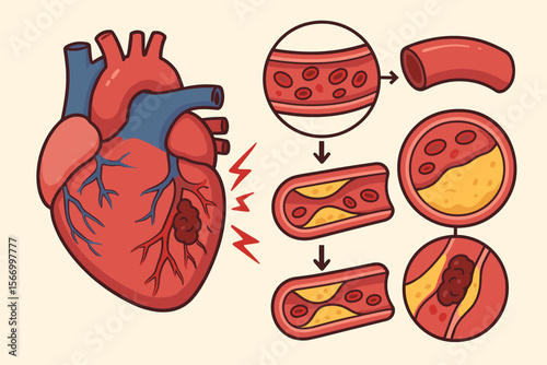 Detailed Medical Vector Illustration of Heart Attack Pathology and Atherosclerosis Progression Showing Artery Blockage, Plaque Buildup, Blood Flow Obstruction, and Cardiac Damage