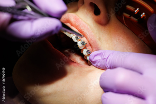 Orthodontist Adjusting Ceramic Braces on Patient Teeth, Close-up , of an orthodontist adjusting clear ceramic braces on a young patient's upper teeth during dental treatment. 