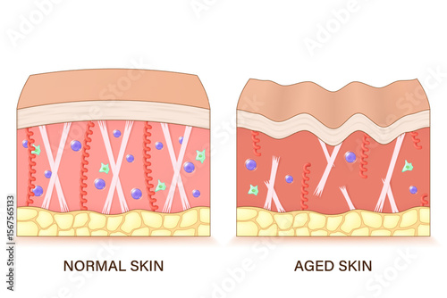 Structure of aged skin. Comparison of normal and aged skin. Facial skin problems. Vector for advertising about beauty and medical treatment.