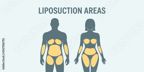 Liposuction areas diagram showing male and female body, plastic surgery concept