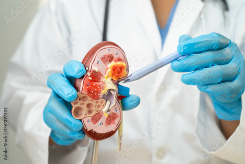 Chronic kidney disease, doctor with model for treatment urinary system, urology, Estimated glomerular filtration rate eGFR.