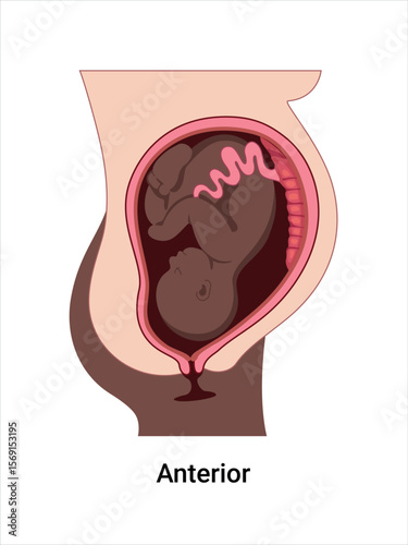 Anterior baby positions in the uterus during pregnancy. Dark-skinned woman. Pathology. Detailed medical vector illustration. Fetus with umbilical cord, placenta.
