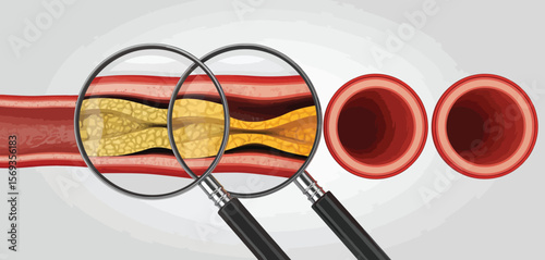 Magnified View of Atherosclerosis in Human Artery