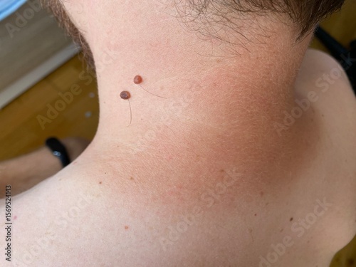 Close-up of human moles on different parts of the body. Natural skin texture with various types of moles (flat, raised, with hair). Useful for dermatology, skin cancer awareness, or medical education. photo