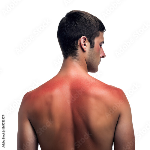 A young Caucasian man with short dark hair shows a sunburned back. The skin is red, indicating overexposure to sunlight. The background is black.