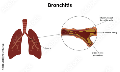 Bronchitis vector illustration