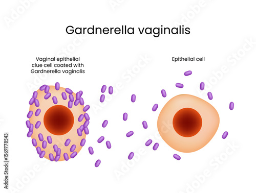 Gardnerella Vaginalis and Clue Cells Bacterial Vaginosis
