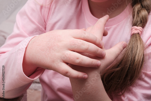 child scratching hands covered with dermatitis, skin allergy in a child, itchy redness on the skin, dry skin of the hands