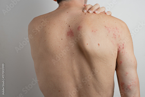 Patient showing skin rash with blisters caused by herpes zoster virus touching his painful shoulder, suffering from chickenpox virus reactivation