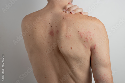 Caucasian man scratching his back and shoulder, suffering from chickenpox virus reactivation known as shingles or herpes zoster, causing itchy and painful red blisters