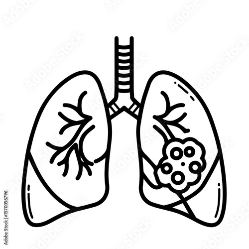 Lungs cancer illustration showcases lungs cancer, outlining affected organ with tumor in monochrome drawing. Depicts lungs cancer as serious pathology, with anatomical details and malignant growth.