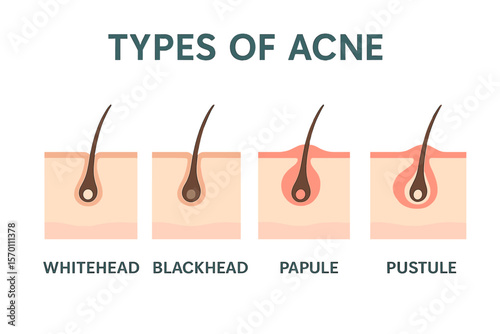 A diagram illustrating various types of acne is presented as a vector image set against a white backdrop, symbolizing a beauty concept