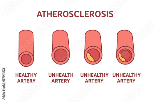 The development of atherosclerosis, comparing healthy and unhealthy arteries