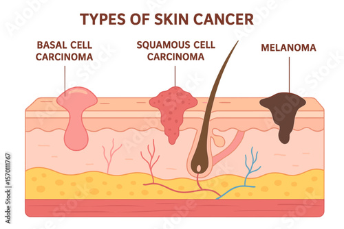 The skin layer is comprised of three types of cancer in a single entity, as depicted in a medical illustration diagram