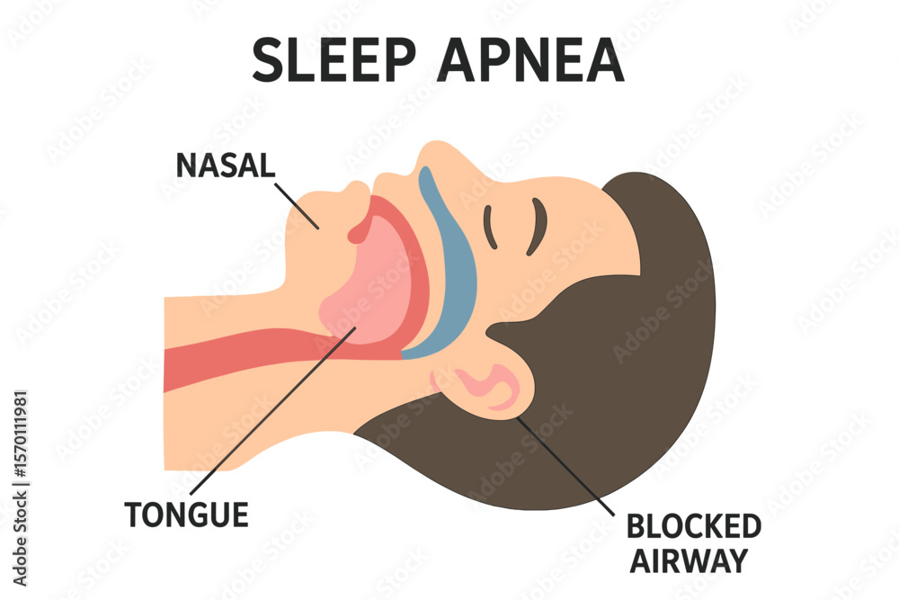 Fototapeta premium Vector illustration of sleep apnea, showing a labeled scheme of the nasal and tongue area blocking the airway
