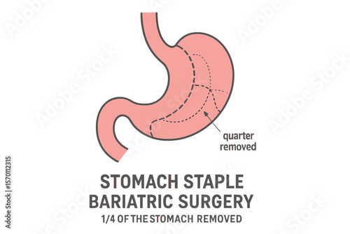 Bariatric stomach staple surgery involves removing a quarter of the stomach