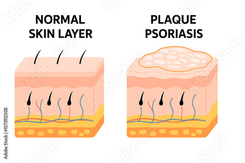 The typical skin layer and skin when signs and symptoms of plaque psoriasis appear, as illustrated in a dermatology diagram