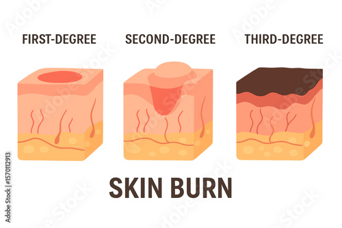 Classification of skin burns includes first, second, and third degree burns