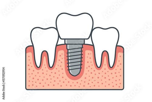 Vector illustration of dental surgery, including a tooth implant cut, healthy teeth, and a dental implant for a stomatology poster, featuring a metal screw in the gum