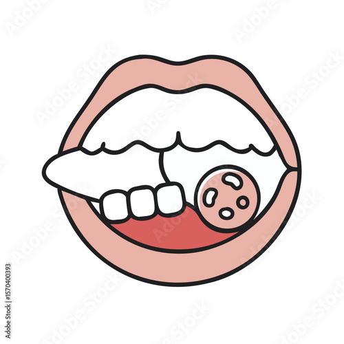 Illustration of an open mouth with a sore