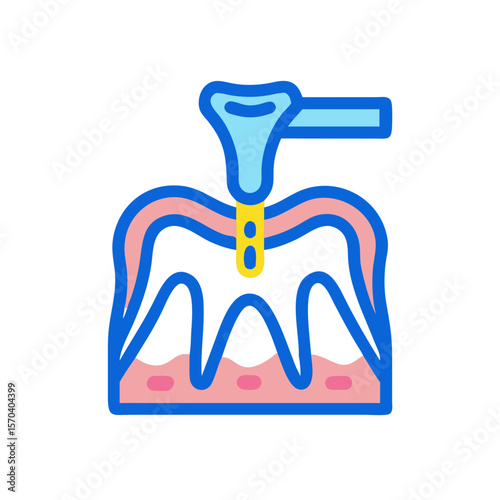 Illustration of dental implant placement with gingiva on White
