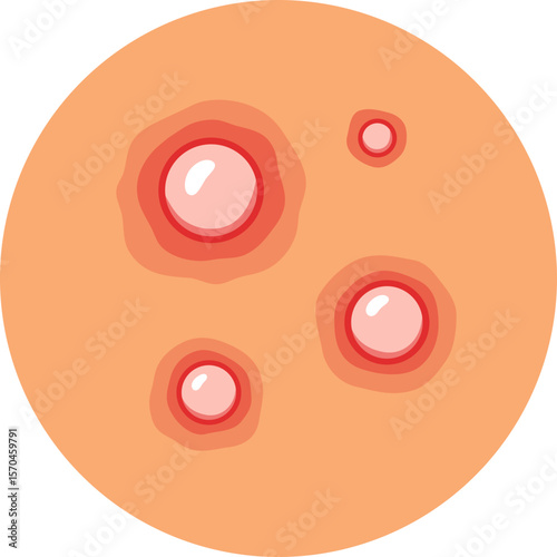 Acnes Skin Problem

