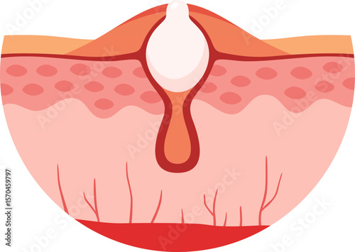 Acne Skin Problem


