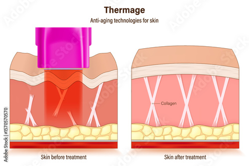 Thermage FLX treatment. Anti-aging technologies for skin. medical cosmetic procedures for skin. Compare skin condition before and after treatment.