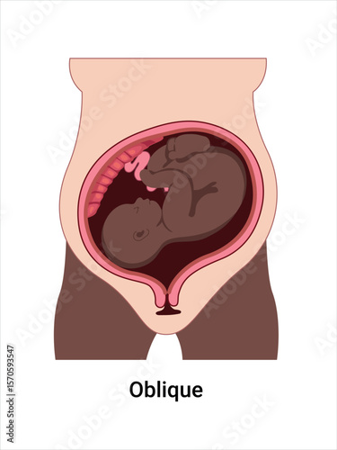 Oblique baby positions in the uterus during pregnancy. Dark-skinned woman. Pathology. Detailed medical vector illustration. Fetus with umbilical cord, placenta.
